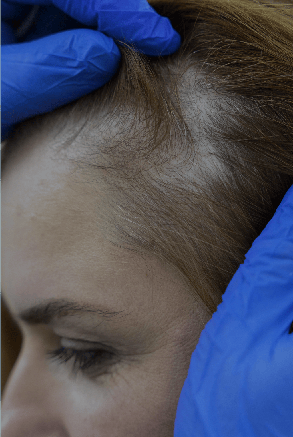 Pilar Cyst treatment panel image