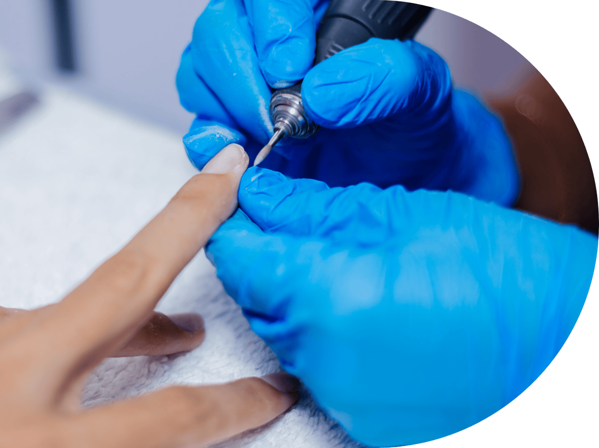 Patient having warts removed from their hand