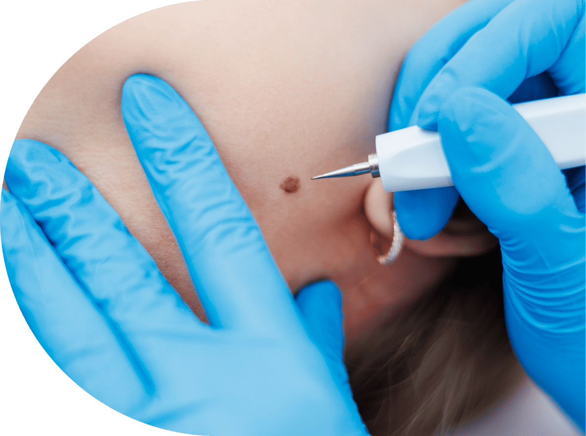 woman having cryopen treatment