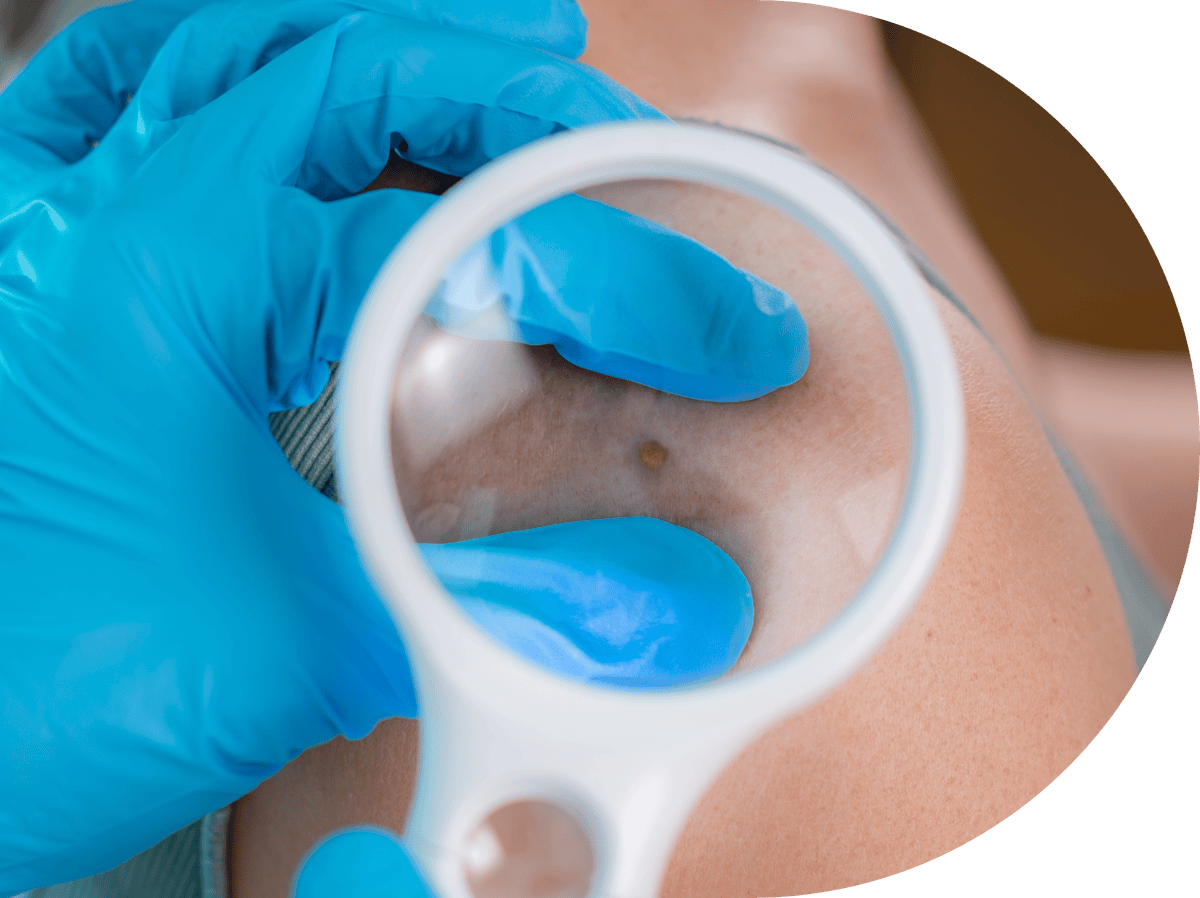 Patient having skin tag examination