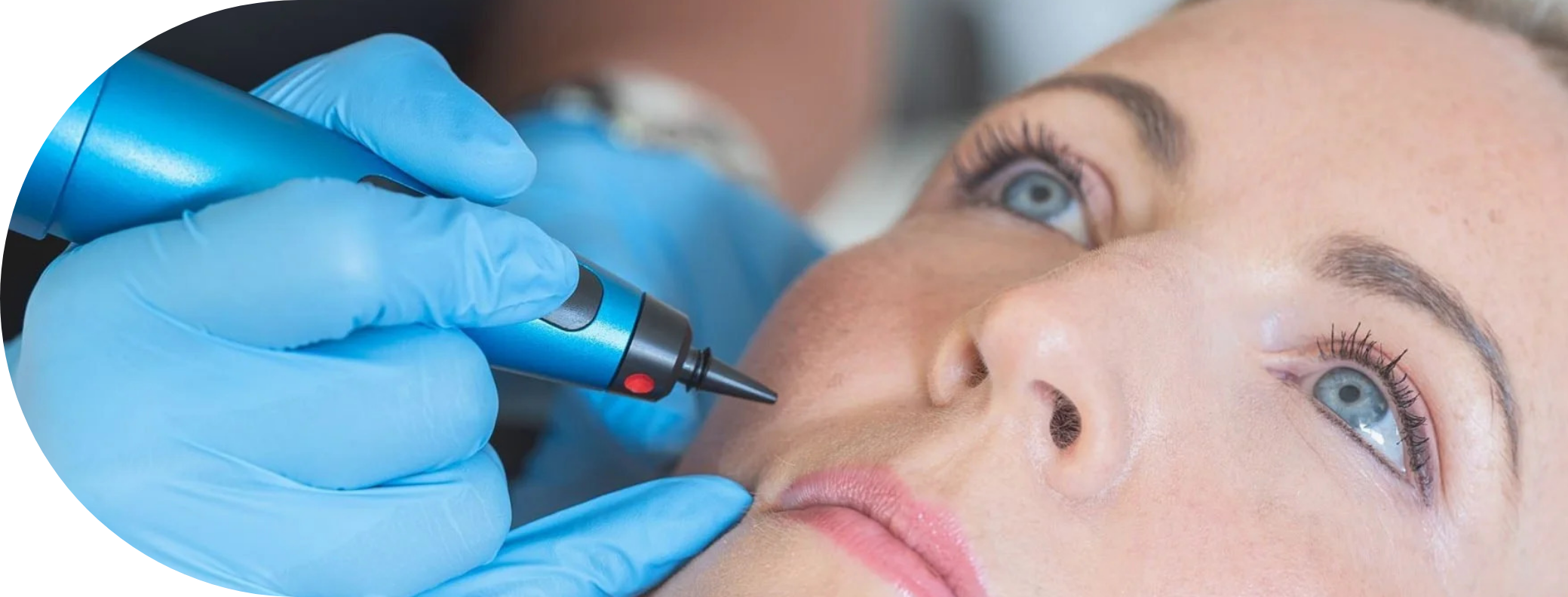 Woman having cryopen skin tag removal treatment