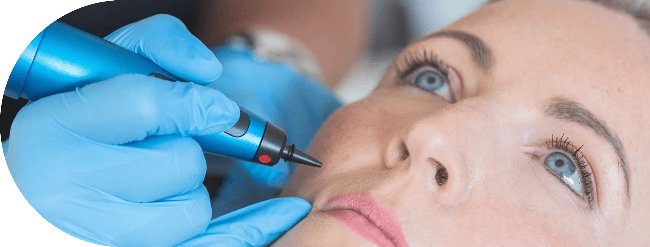 Woman having cryopen skin tag removal treatment