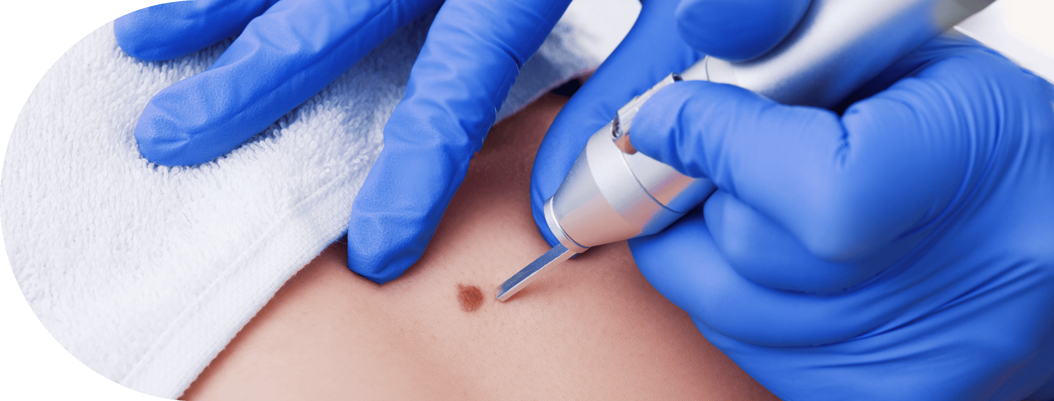 woman having her mole removed using cryopen treatment