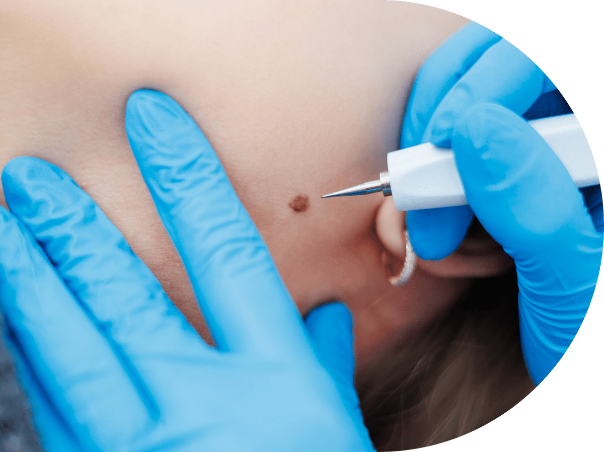 woman having cryopen treatment on her mole