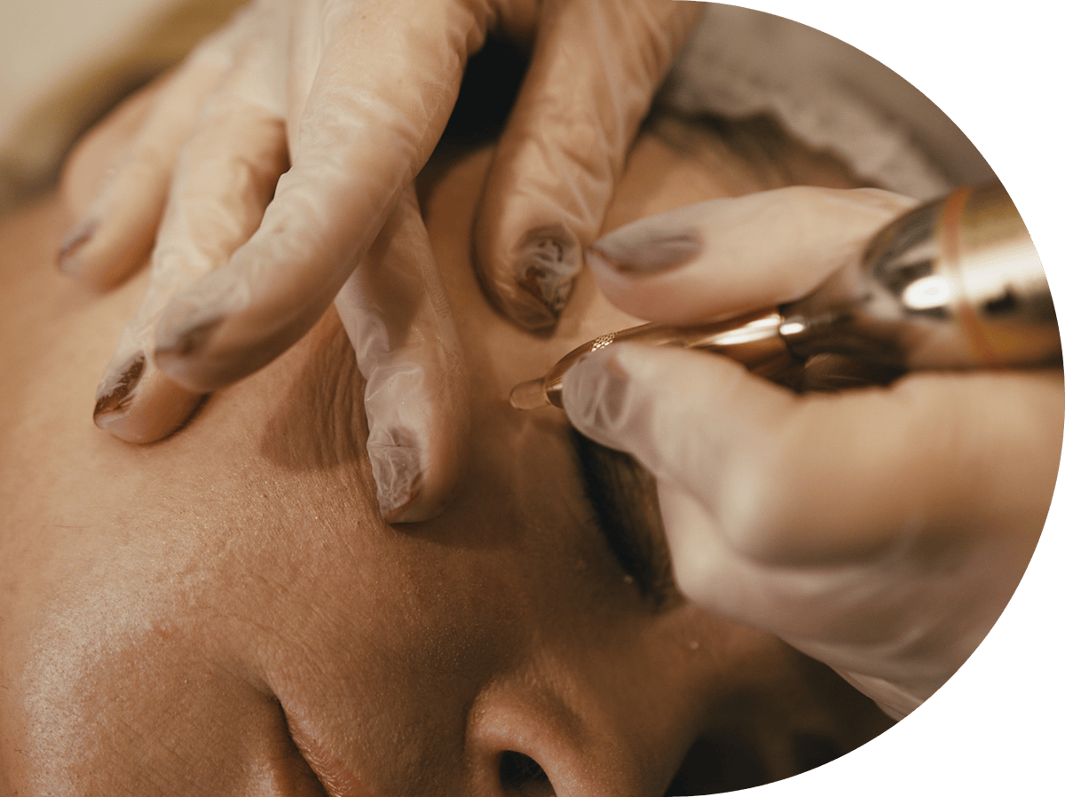 woman having sun spots treatment with cryopen