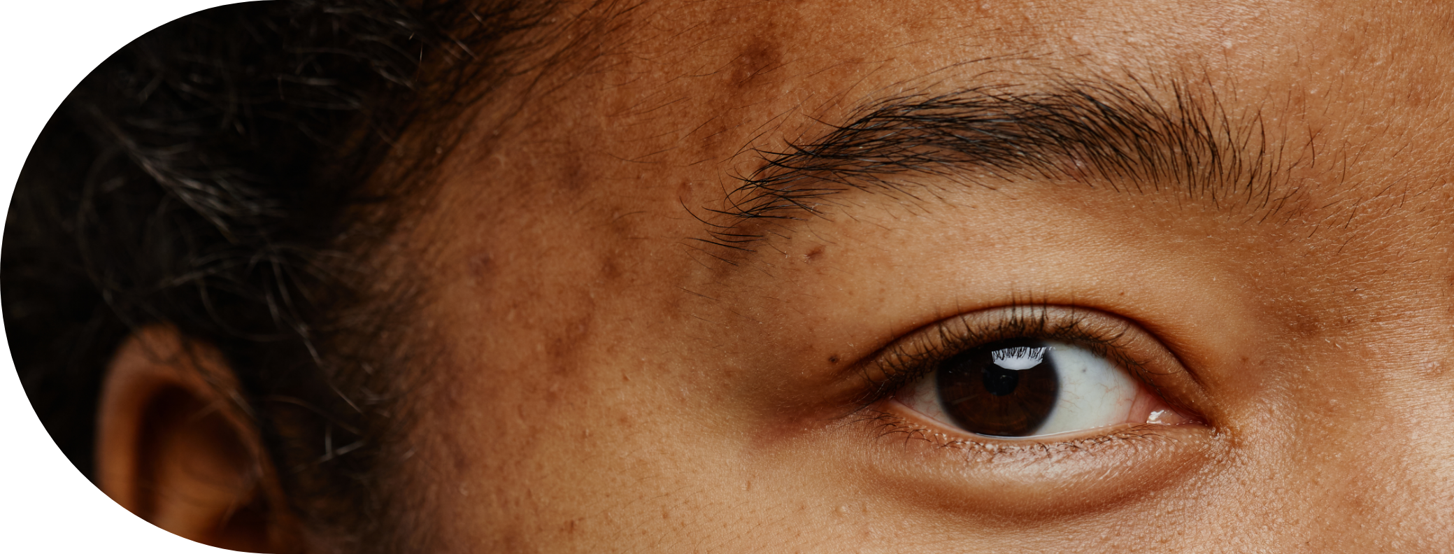 Black woman with sun spots