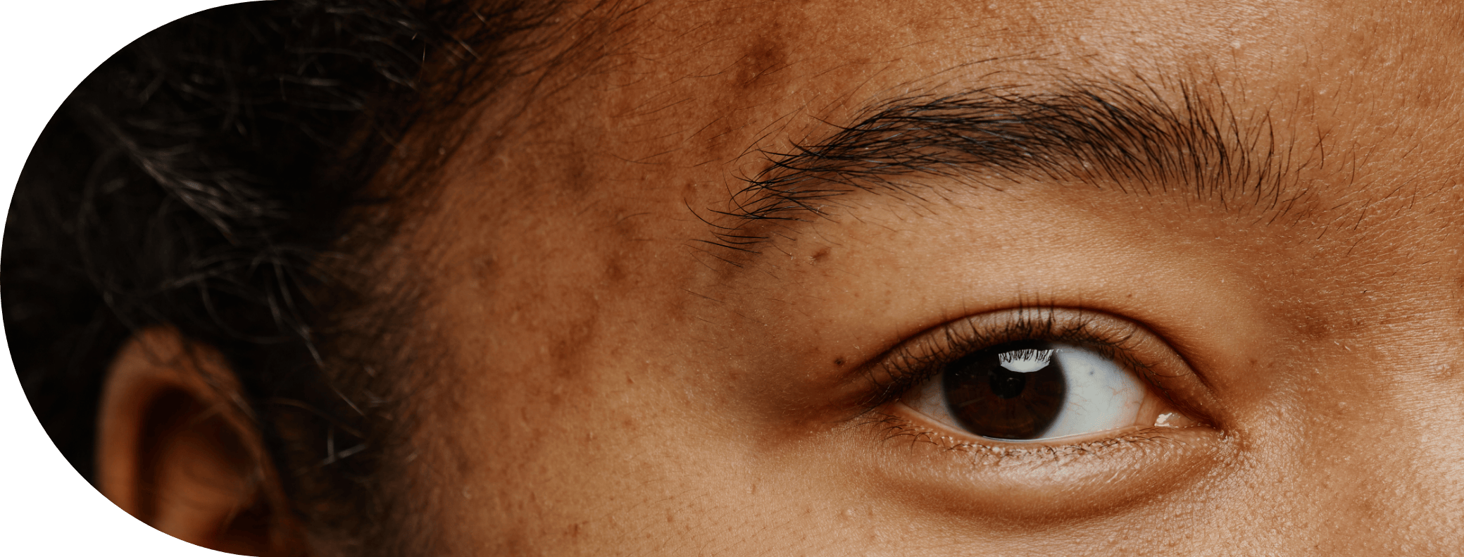 Black woman with sun spots