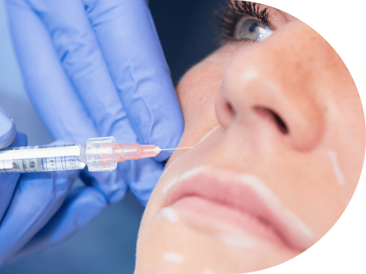 a woman with a marked up face for anti wrinkle treatment