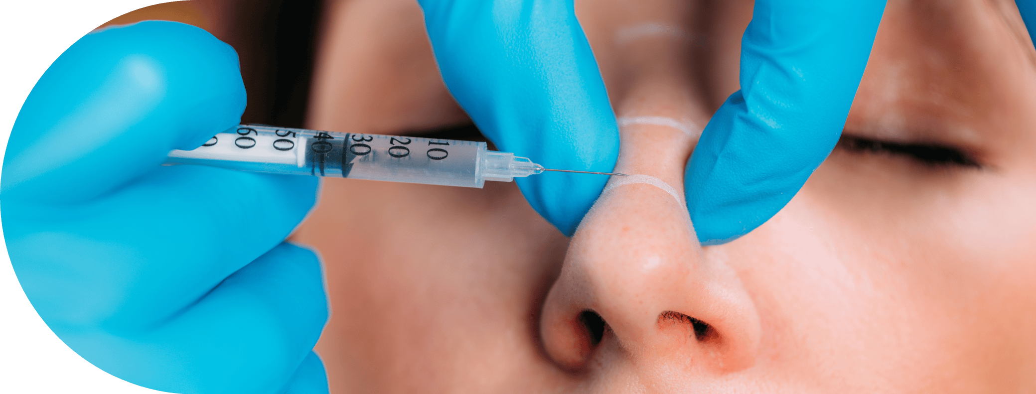 woman having bunny lines treatment on her nose