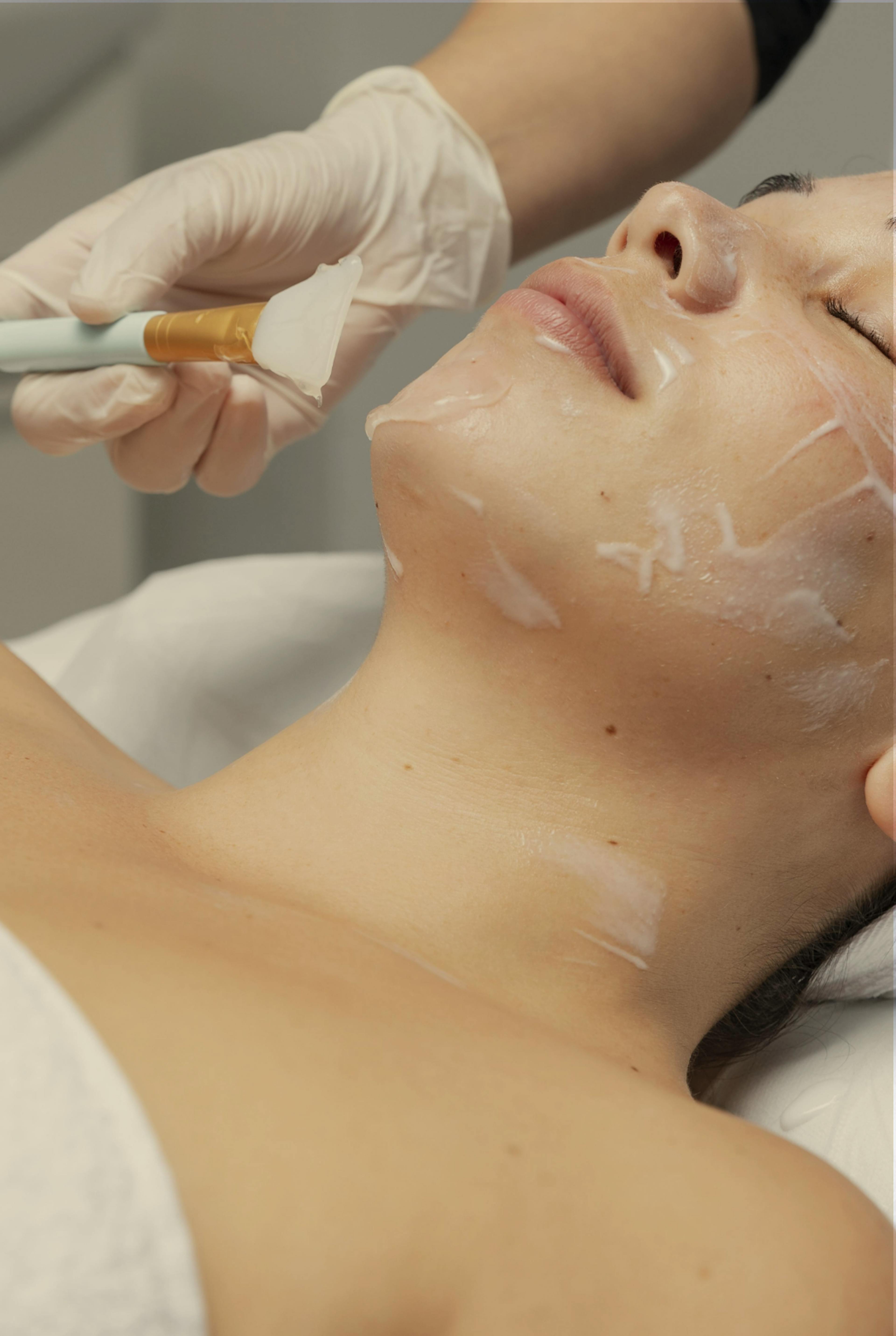 woman having Cosmelan peel treatment
