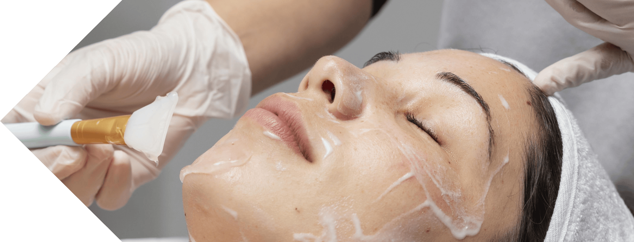 Cosmelan peel treatment being performed