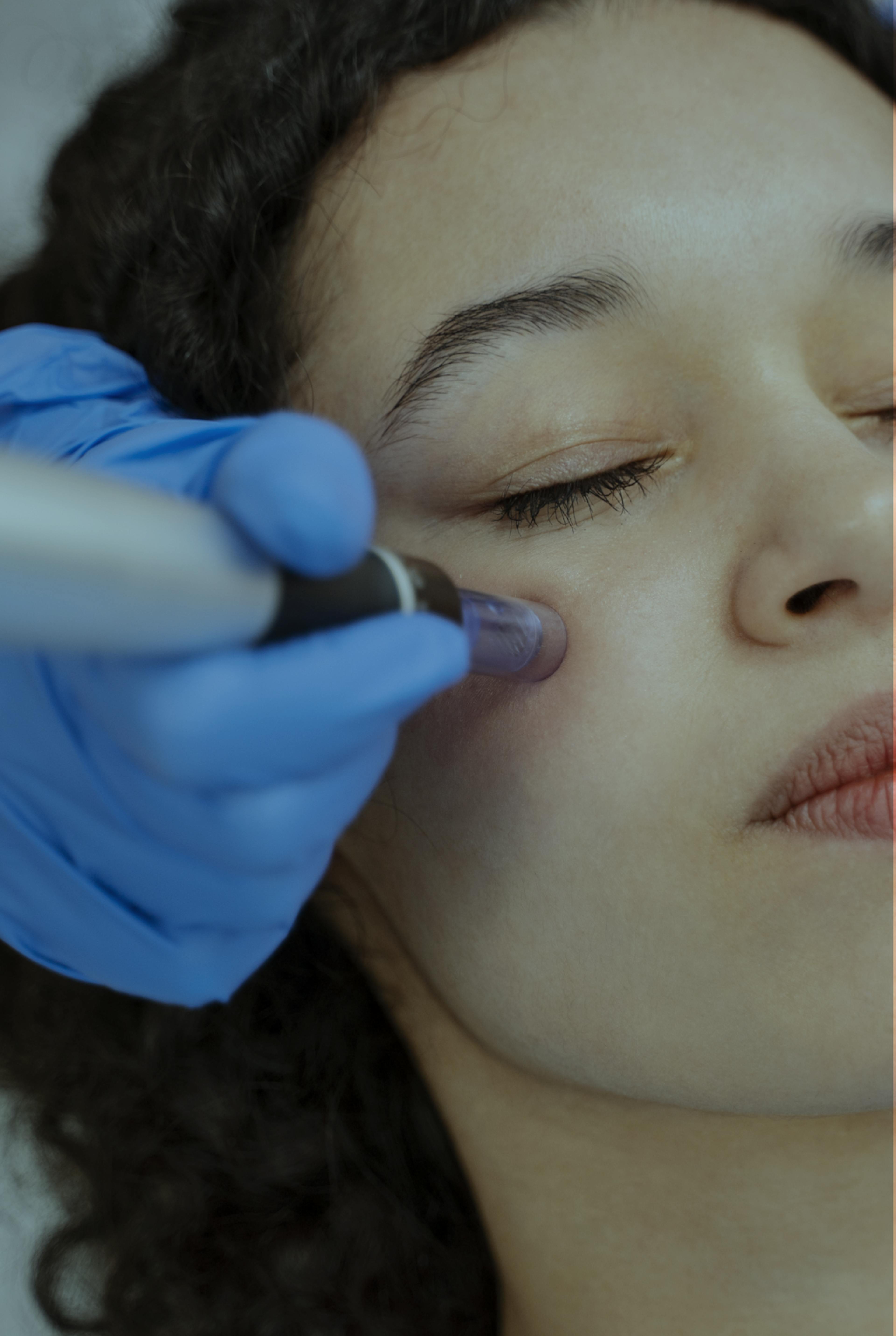 woman having micro needling treatment on her cheek