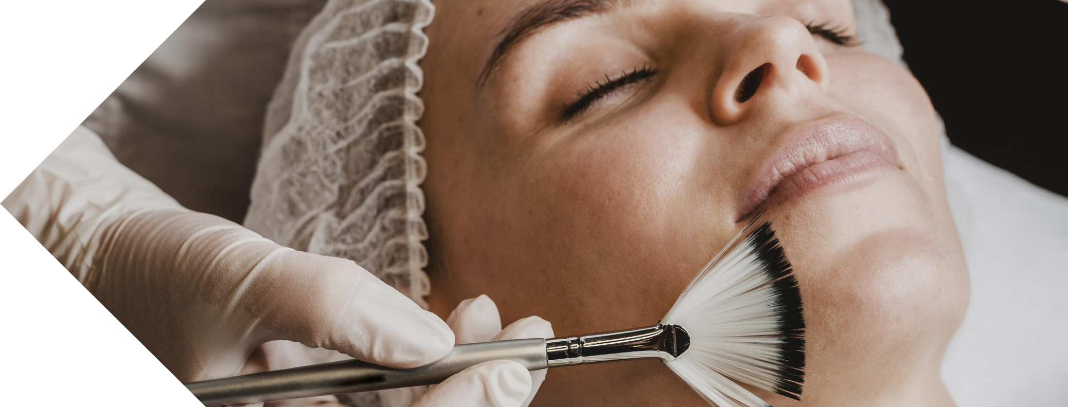 mesopeel treatment being performed on a woman