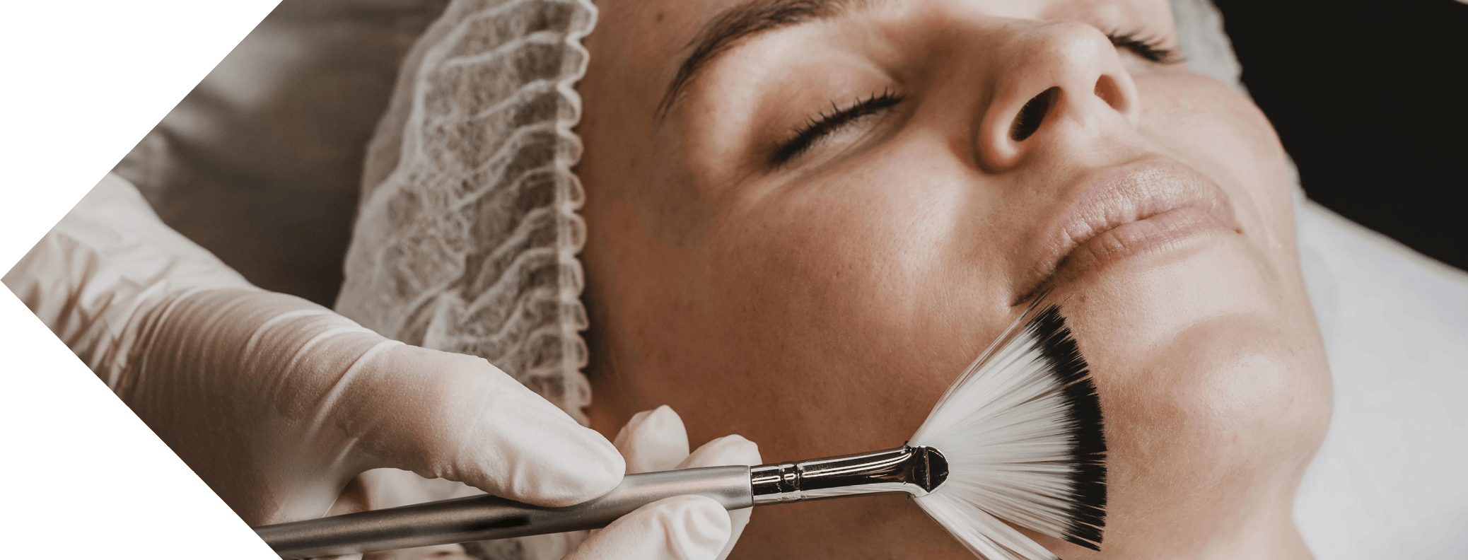 mesopeel treatment being performed on a woman