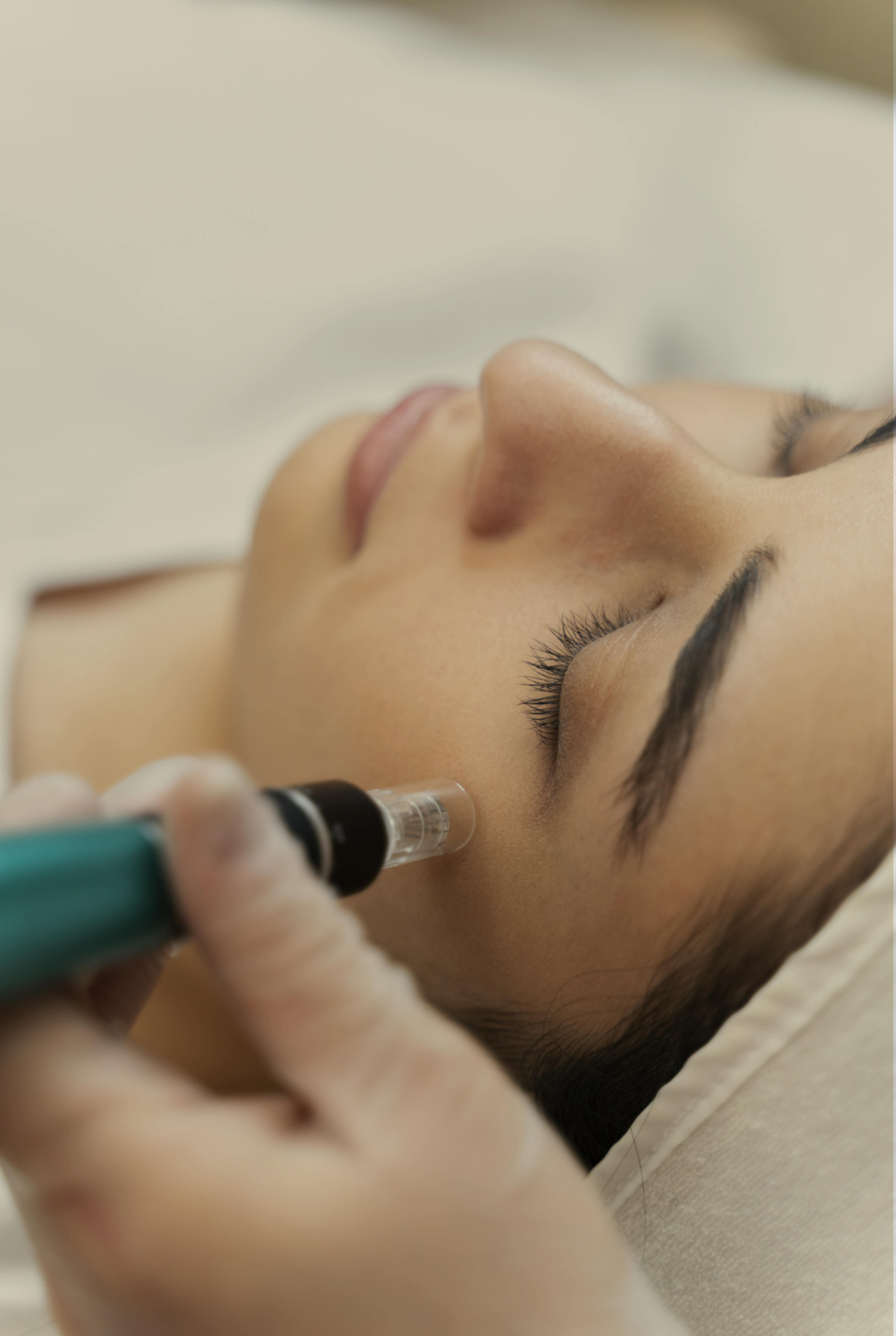 close up of a girl having micro needling treatment