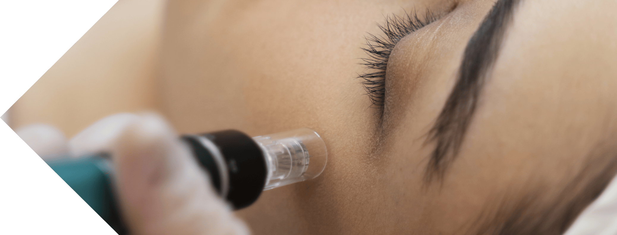 close up of micro needling being performed