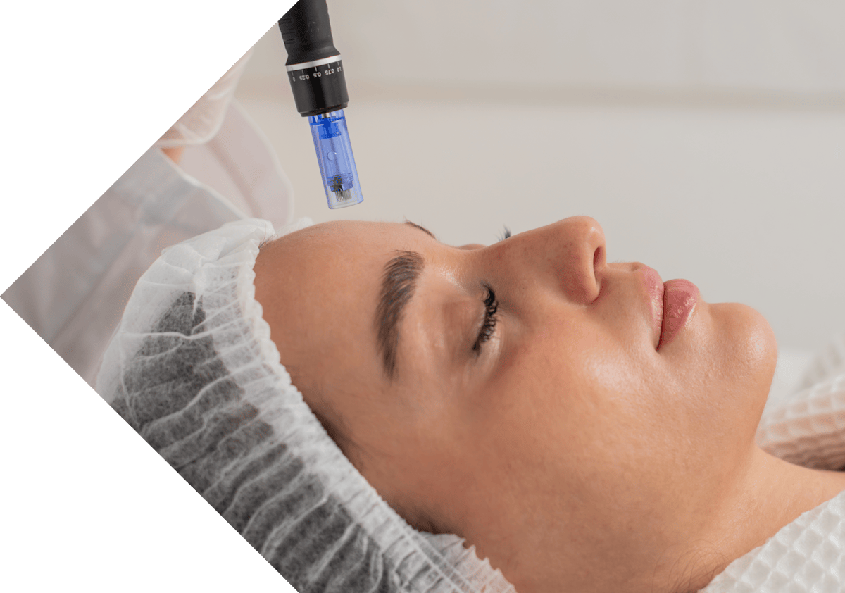 side view of a woman having micro needling treatment