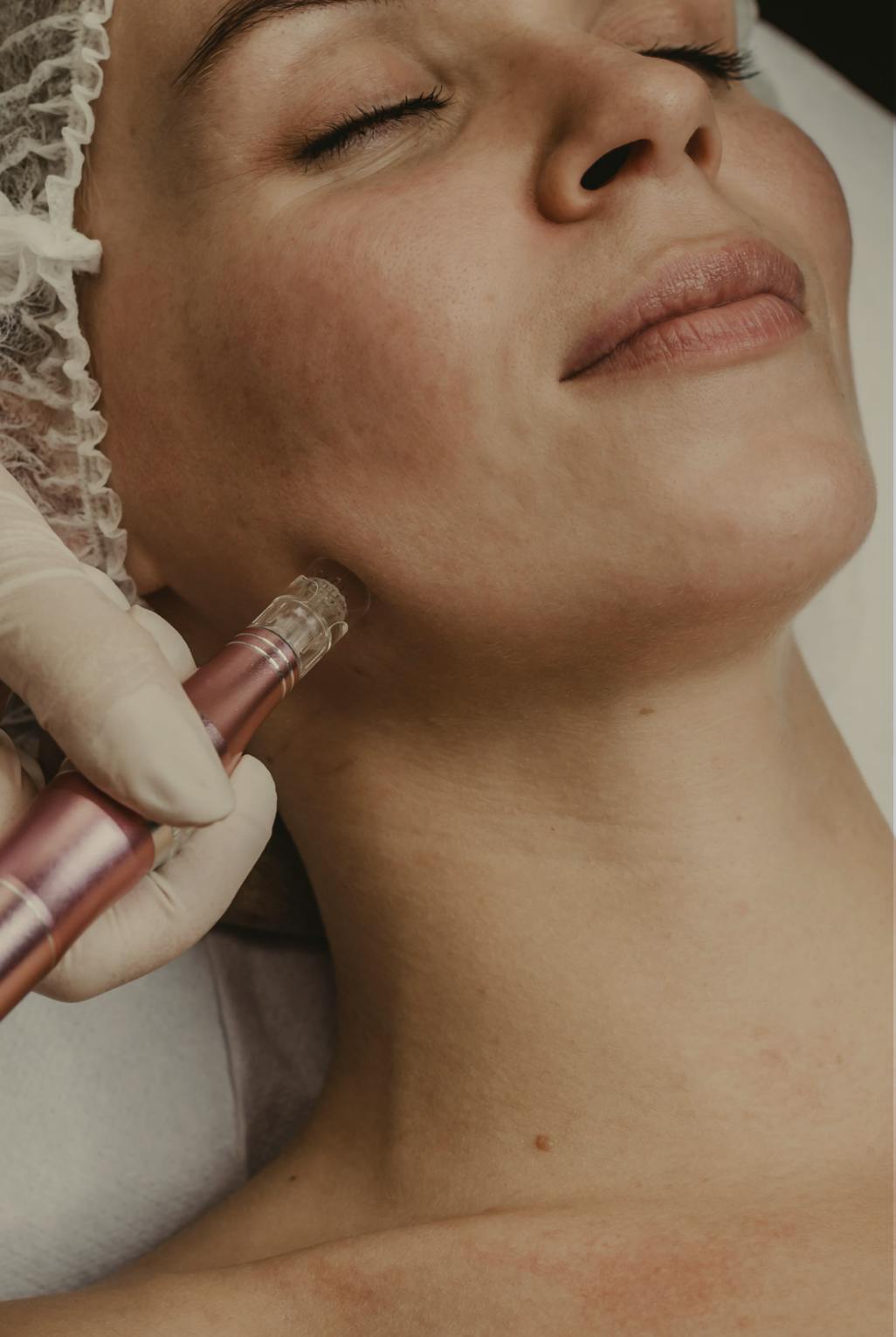 woman having neck micro needling treatment