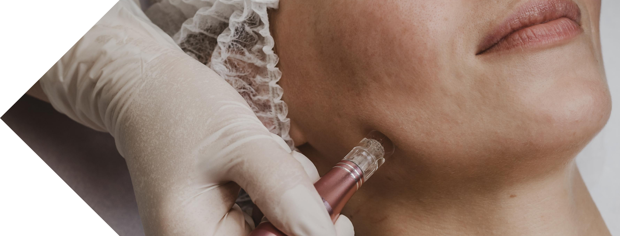 close up of a woman having micro needling treatment on her neck