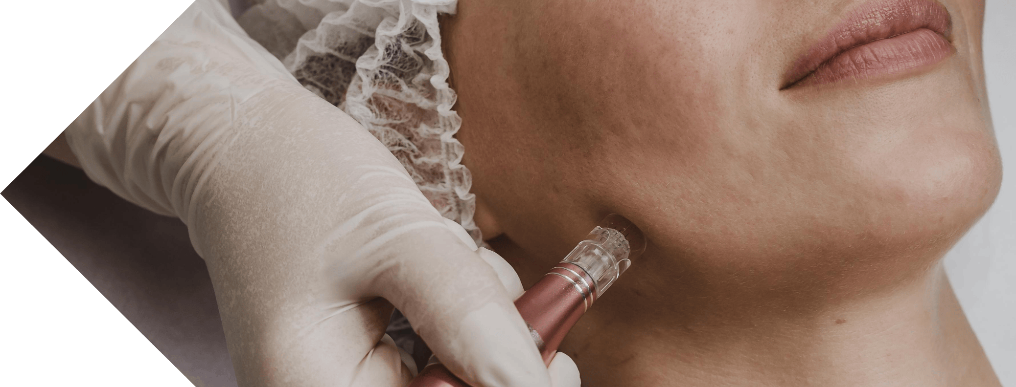 close up of a woman having micro needling treatment on her neck