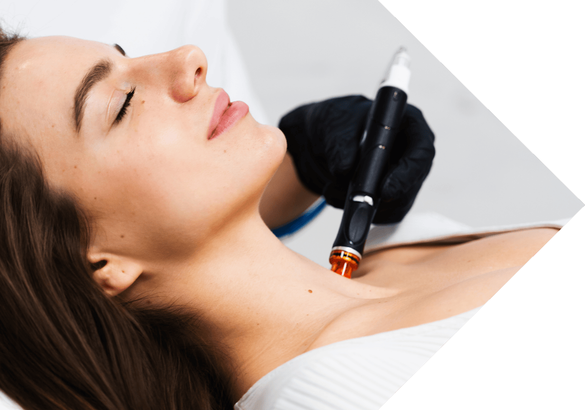 neck micro needling treatment