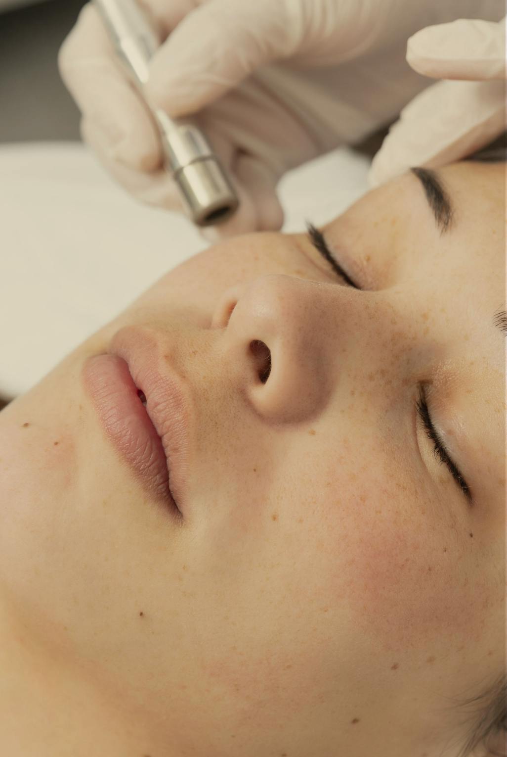 micro needling cheeks treatment on a woman