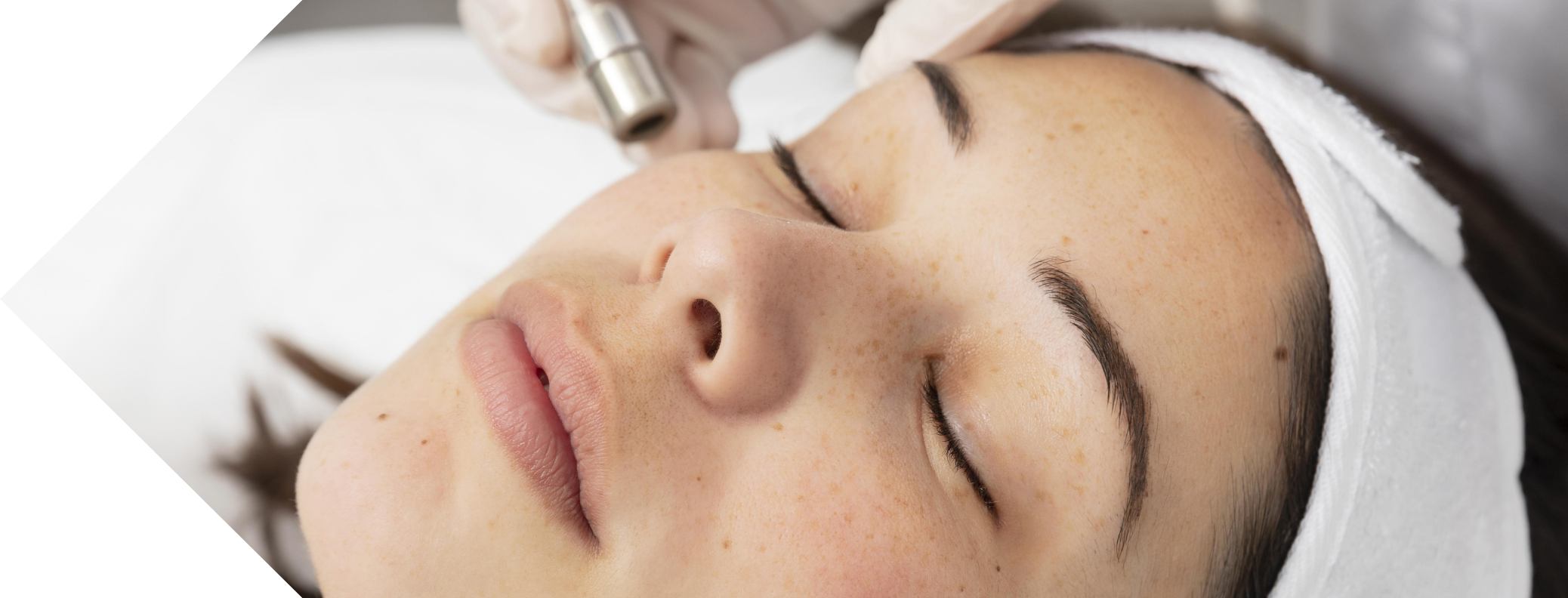 woman having micro needling on her cheeks