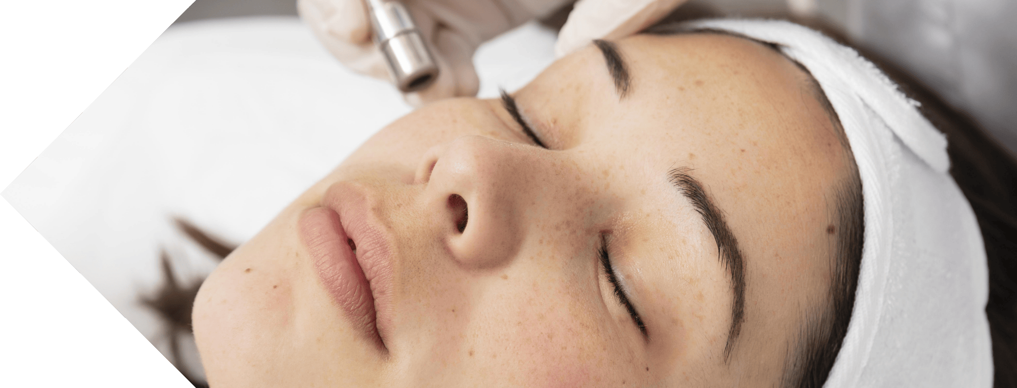 woman having micro needling on her cheeks
