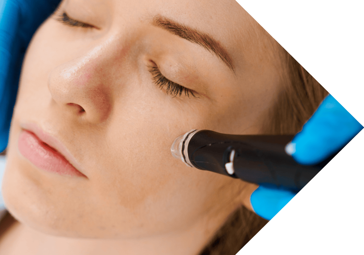 micro needling cheeks treatment being performed