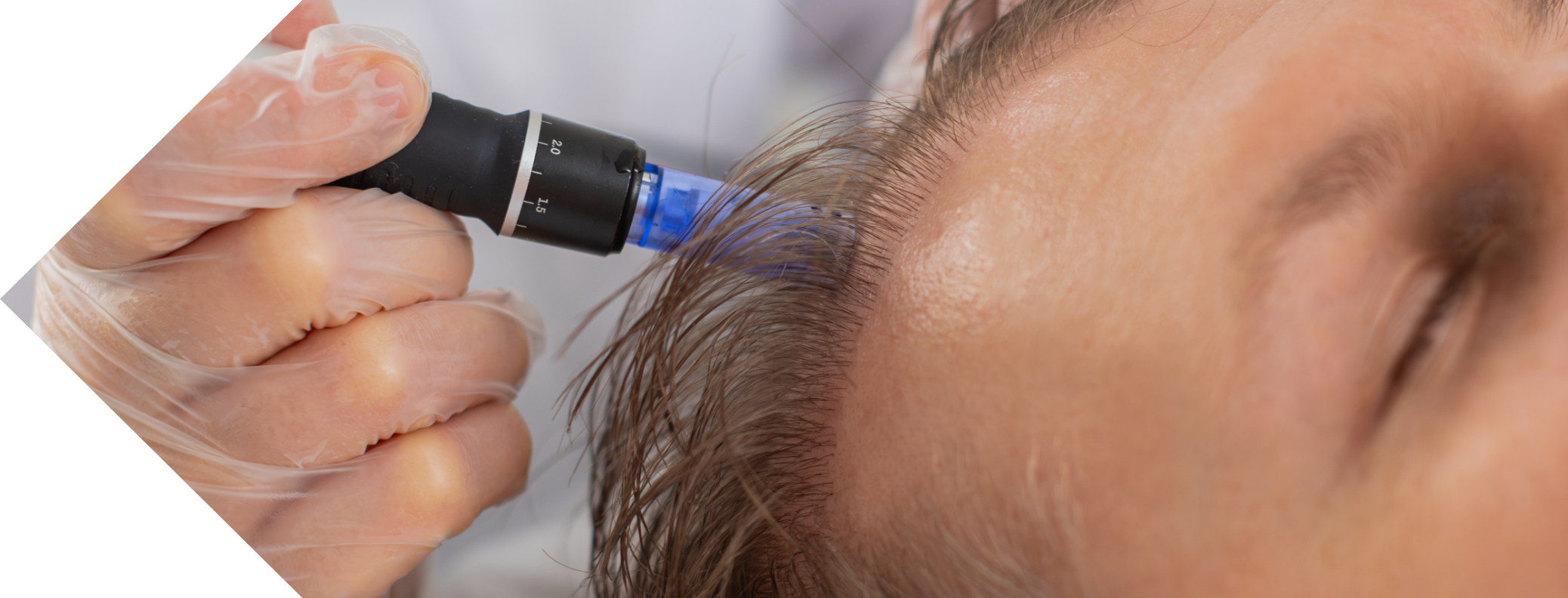 close up of man having hair loss treatment