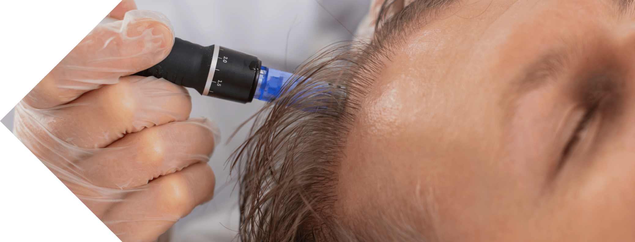 close up of man having hair loss treatment