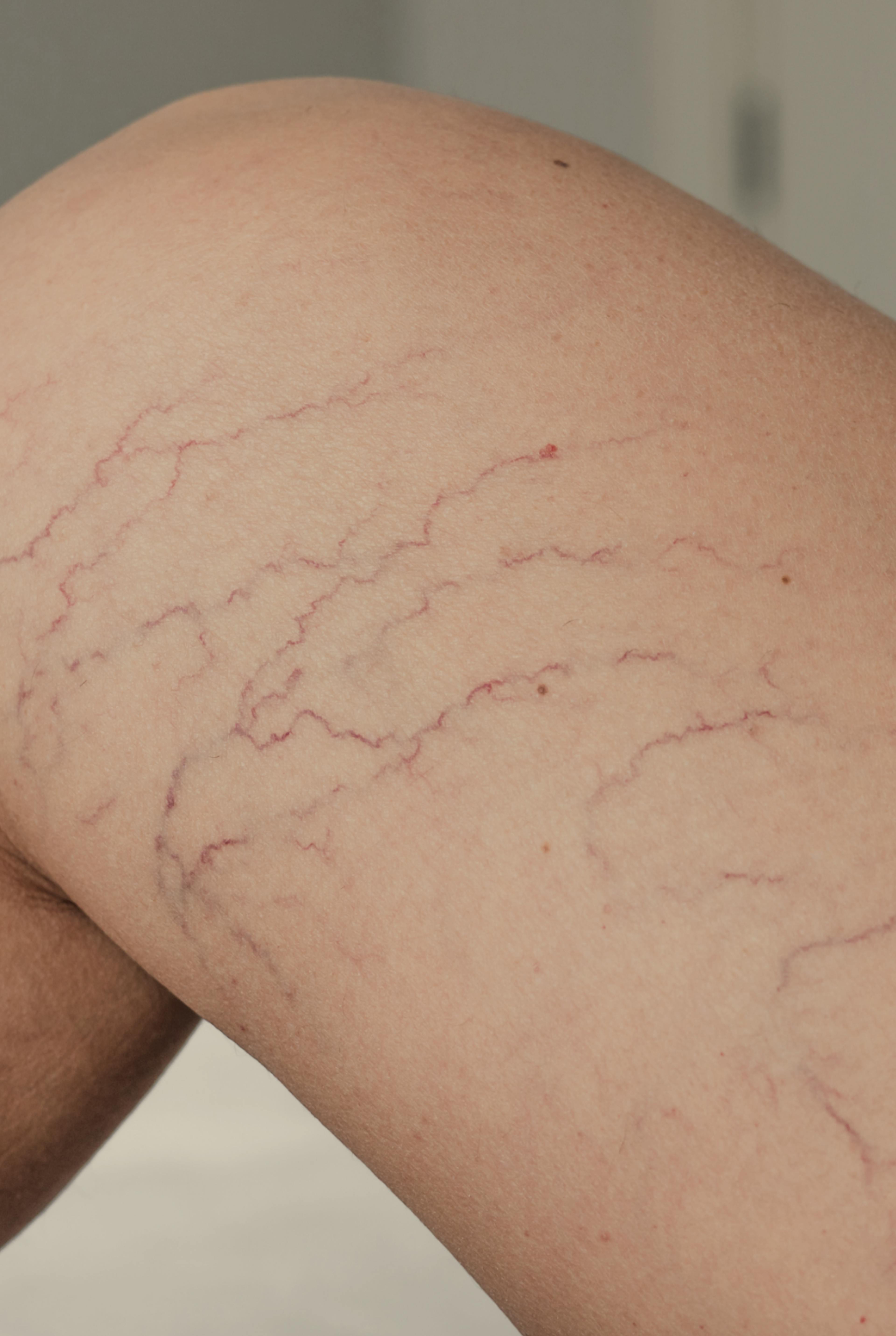 thread veins on a leg