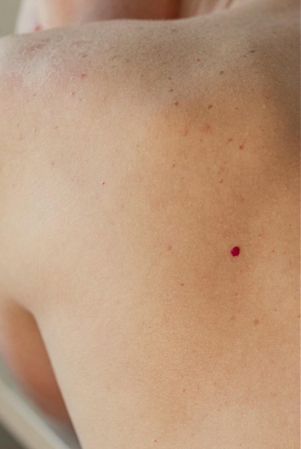 A man with a Cherry Angioma on his back