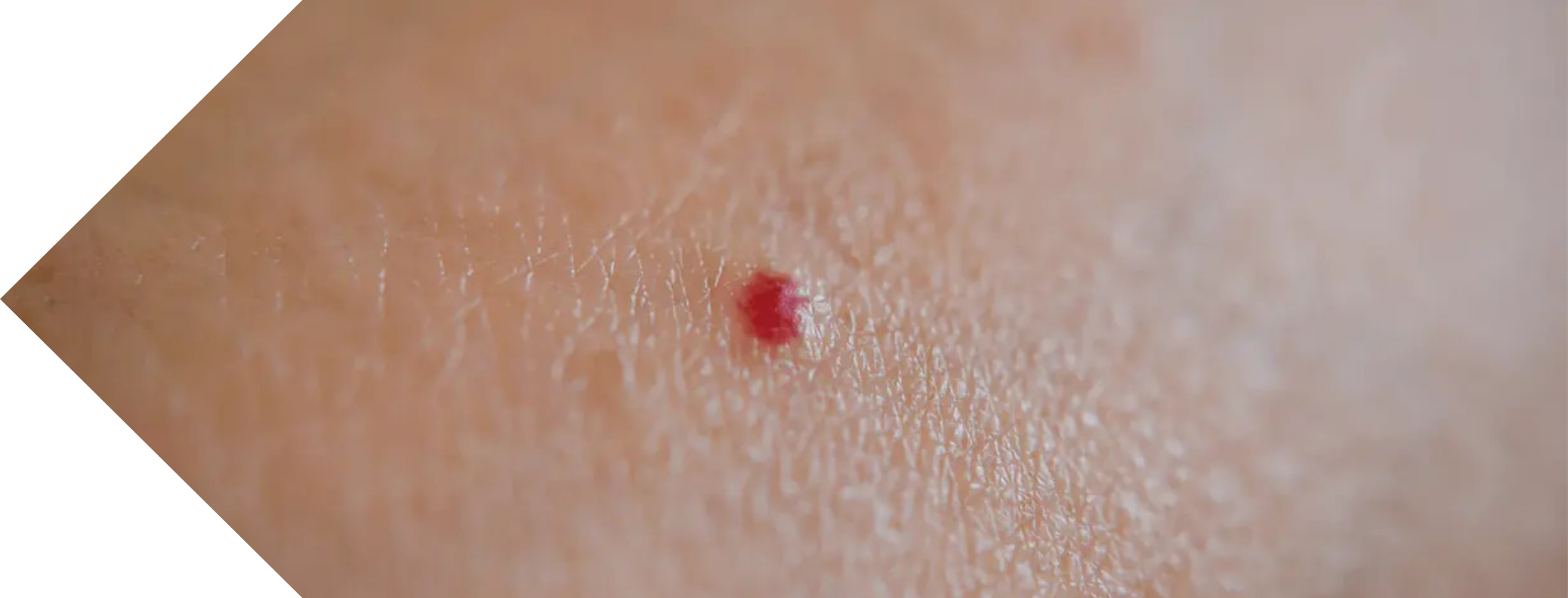 close up of a Cherry Angioma