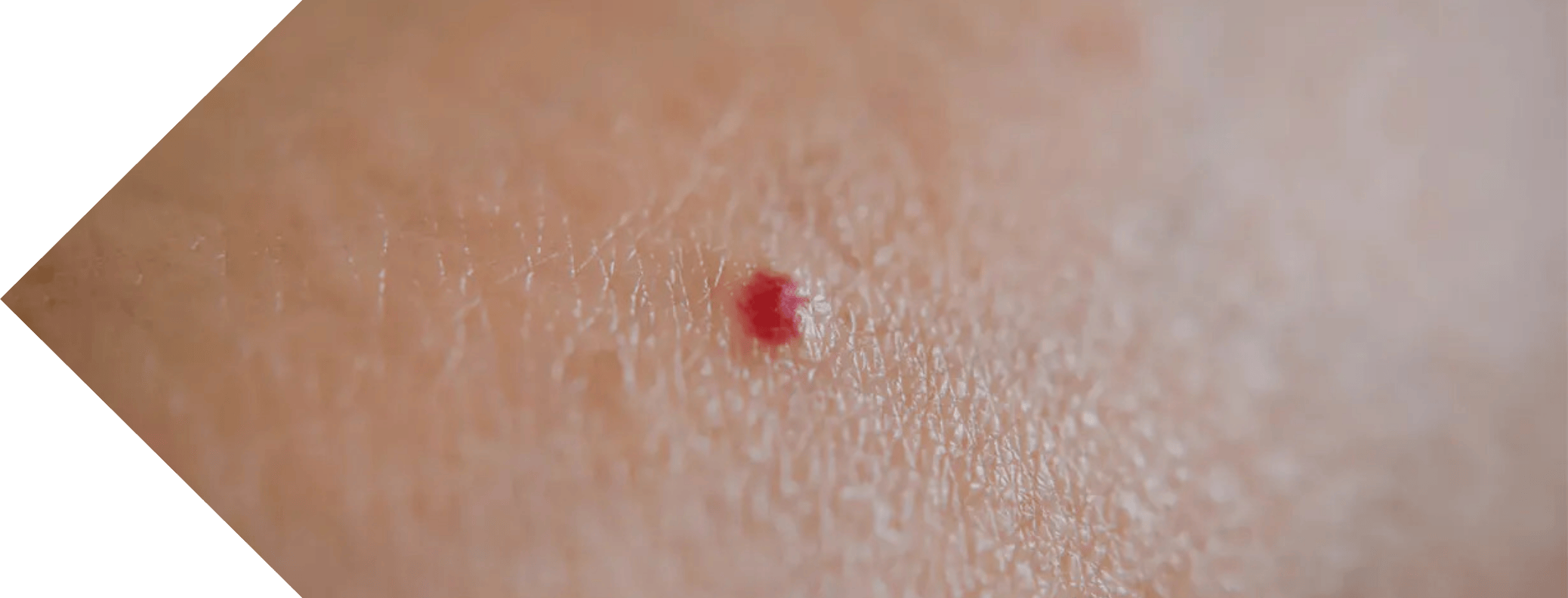 close up of a Cherry Angioma