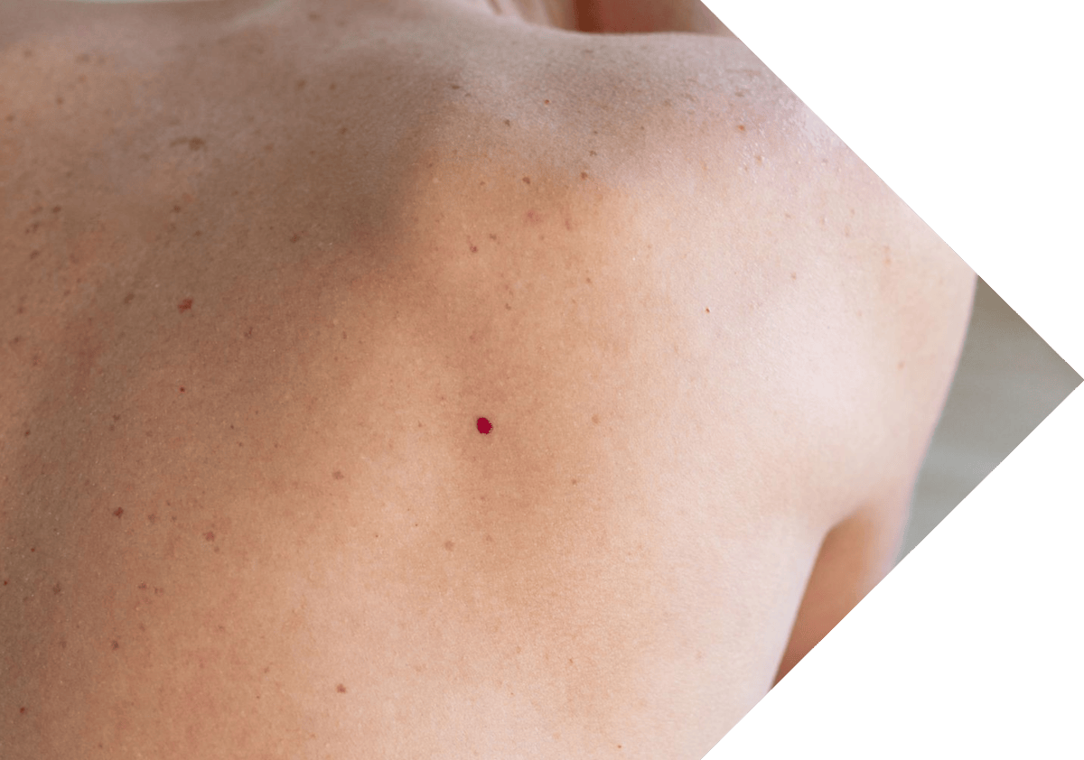A man with a Cherry Angioma on his back