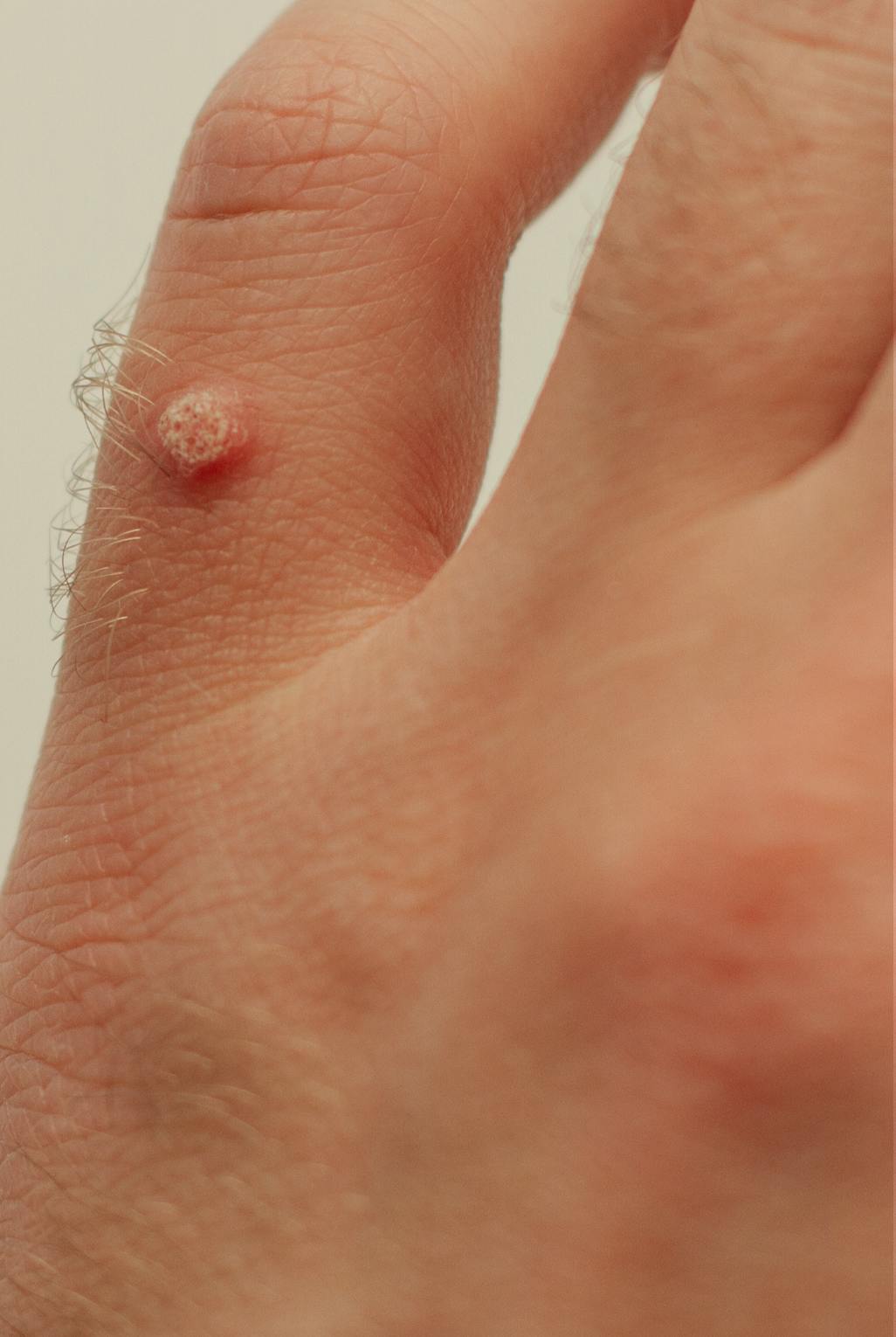 mans hand with a wart on the finger