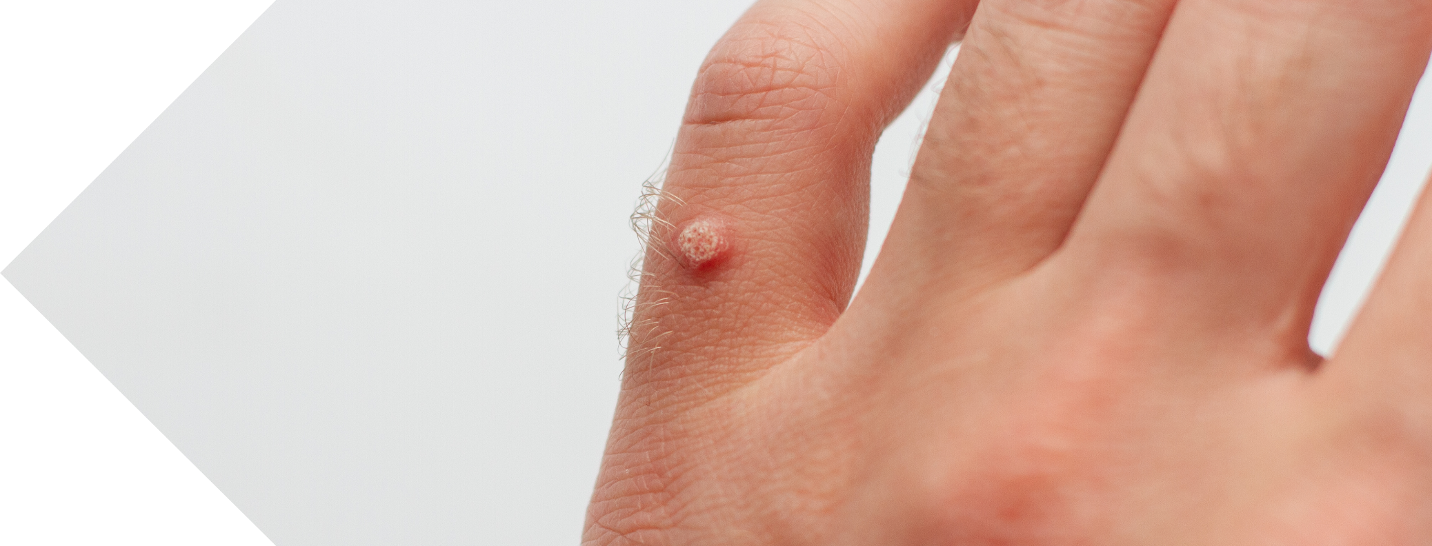 mans hand with a wart on the finger