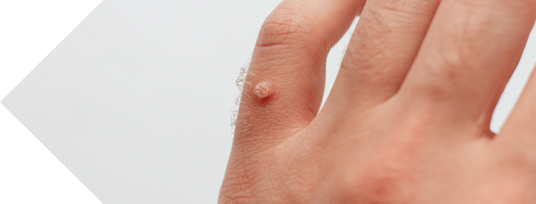 mans hand with a wart on the finger