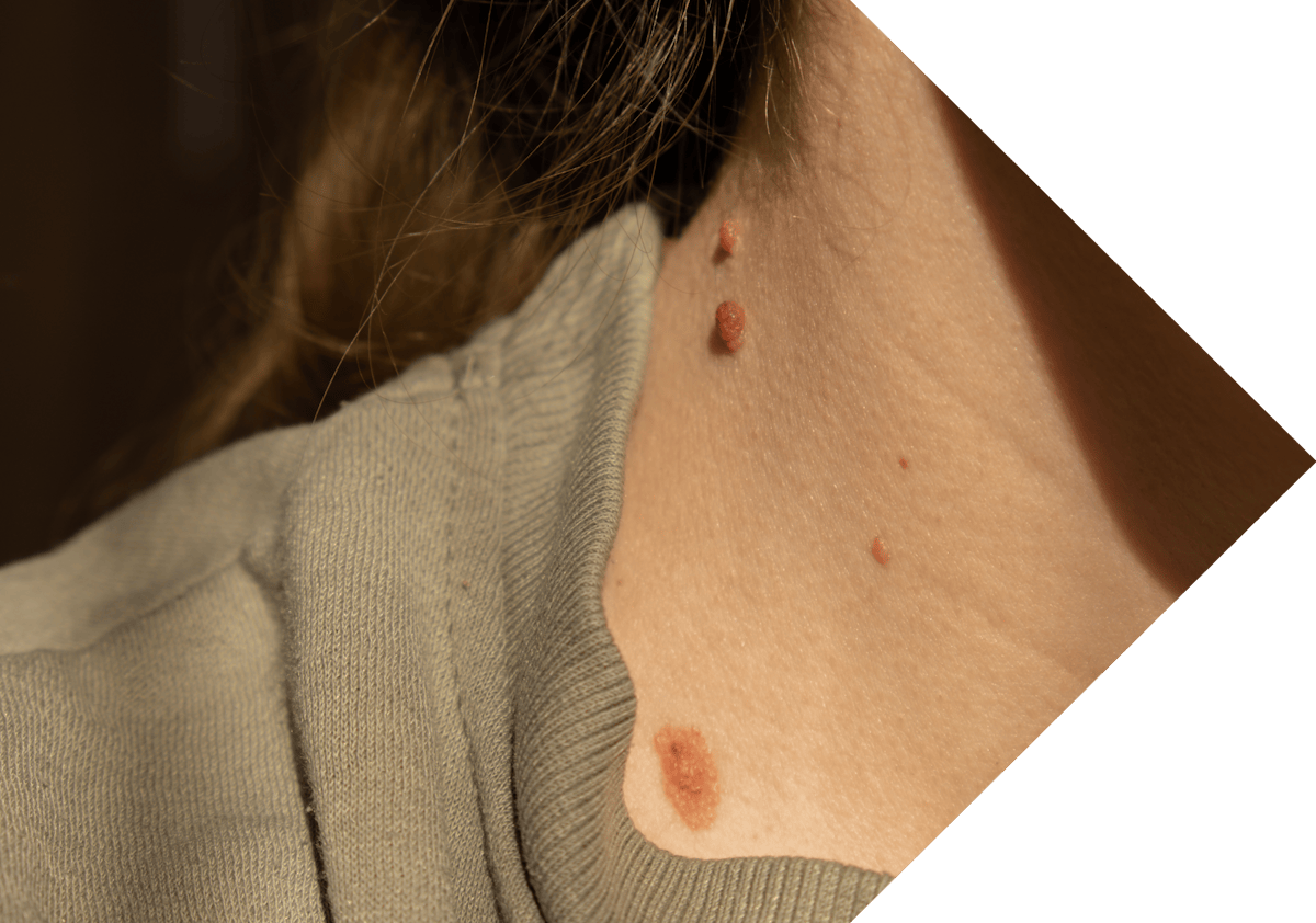 a woman with warts on her neck