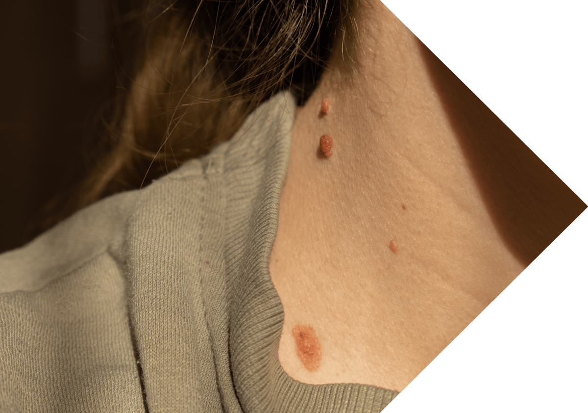 a woman with warts on her neck