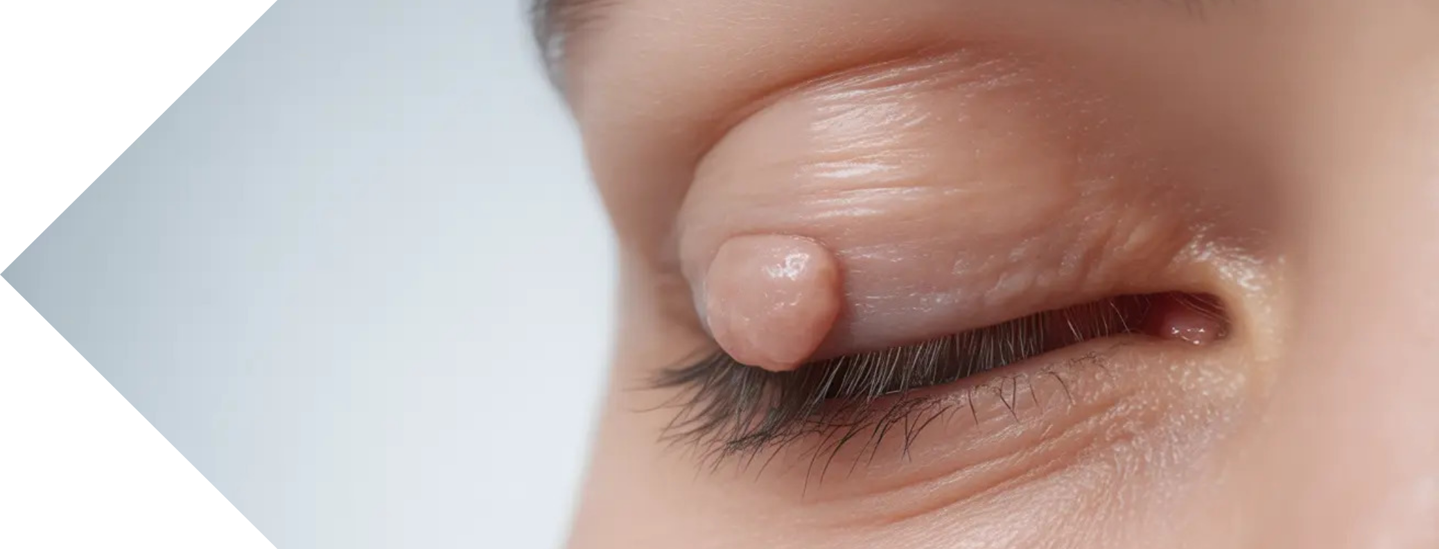 close up of an eye with a skin tag