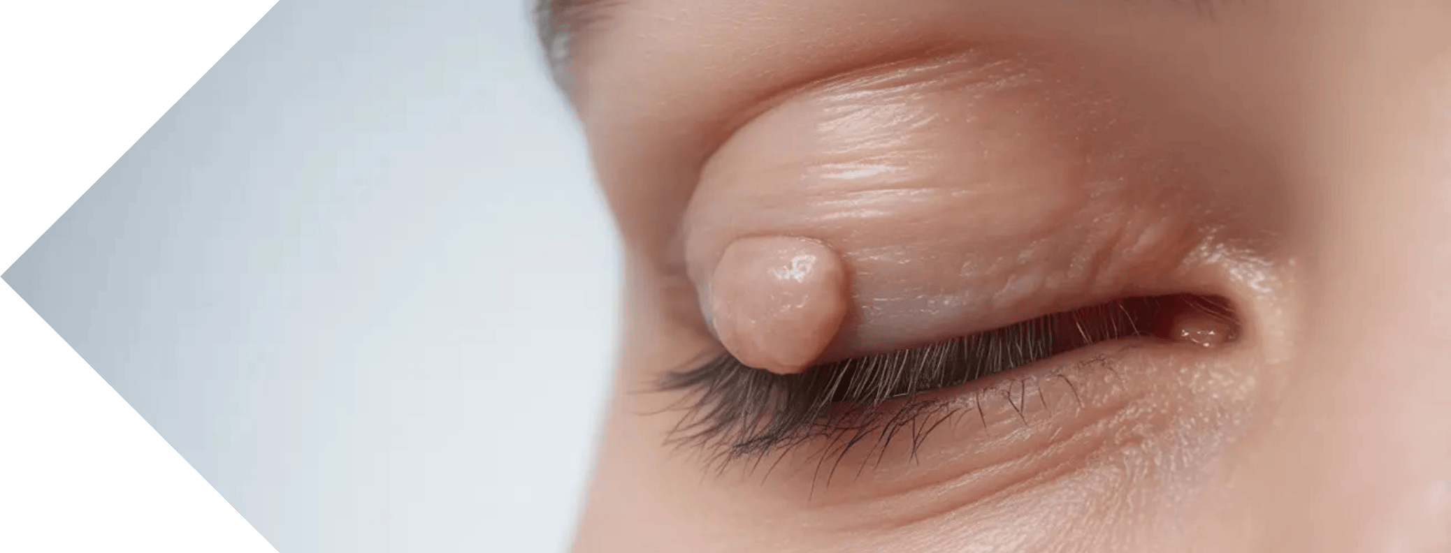 close up of an eye with a skin tag