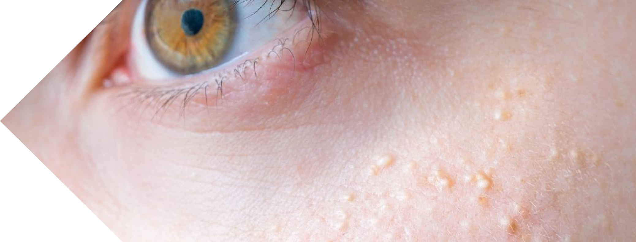 close up of a face with milia