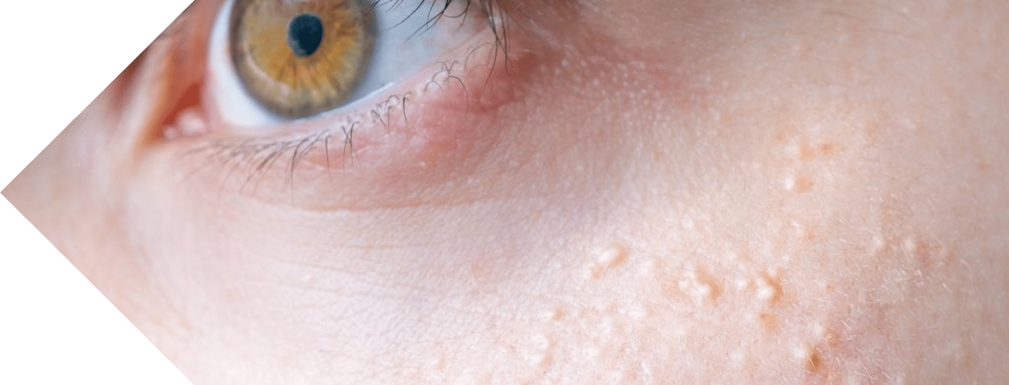 close up of a face with milia