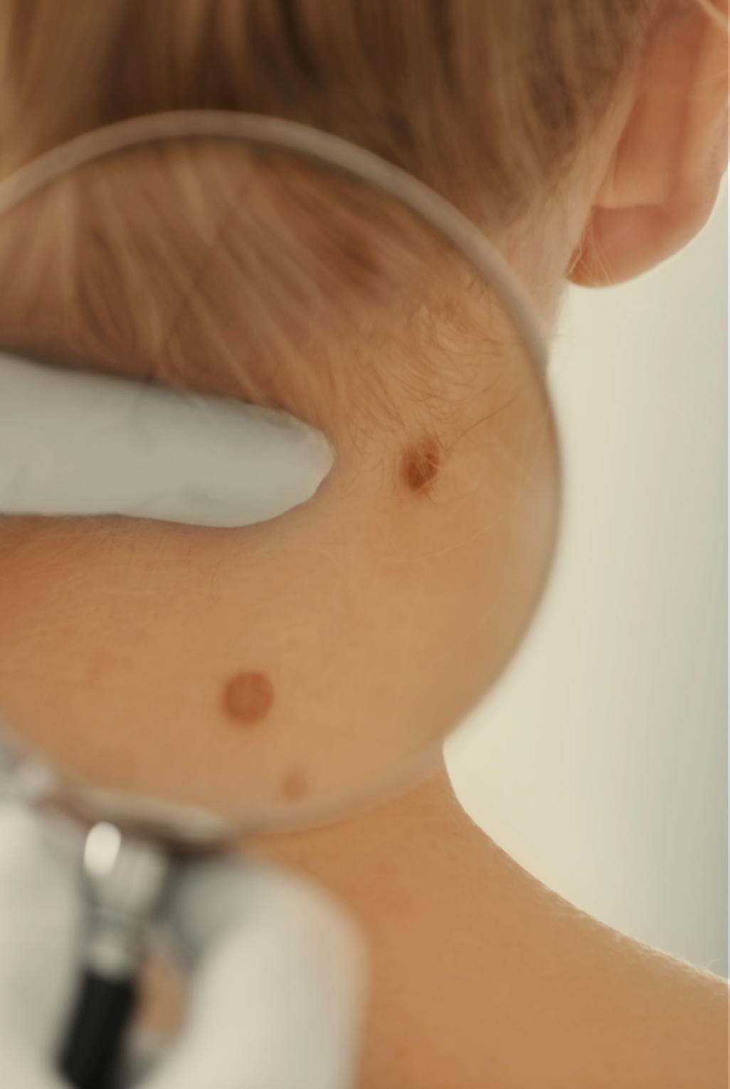 woman having her skin tags examined