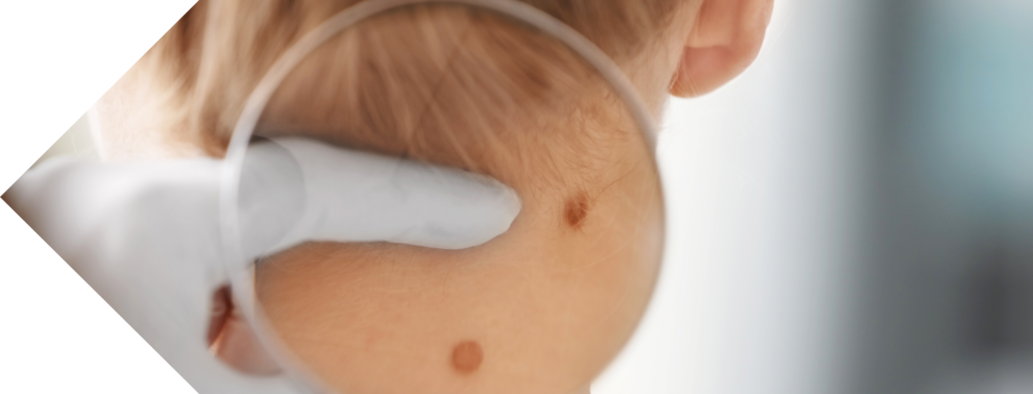 skin tag examination
