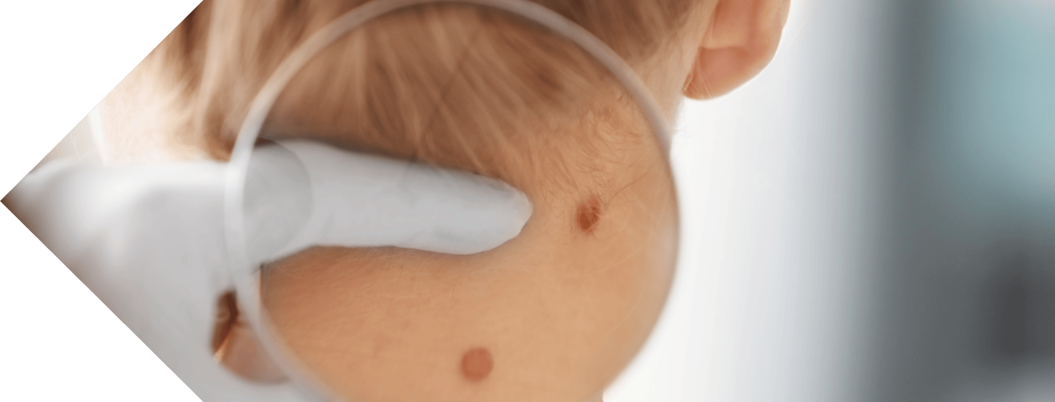 skin tag examination
