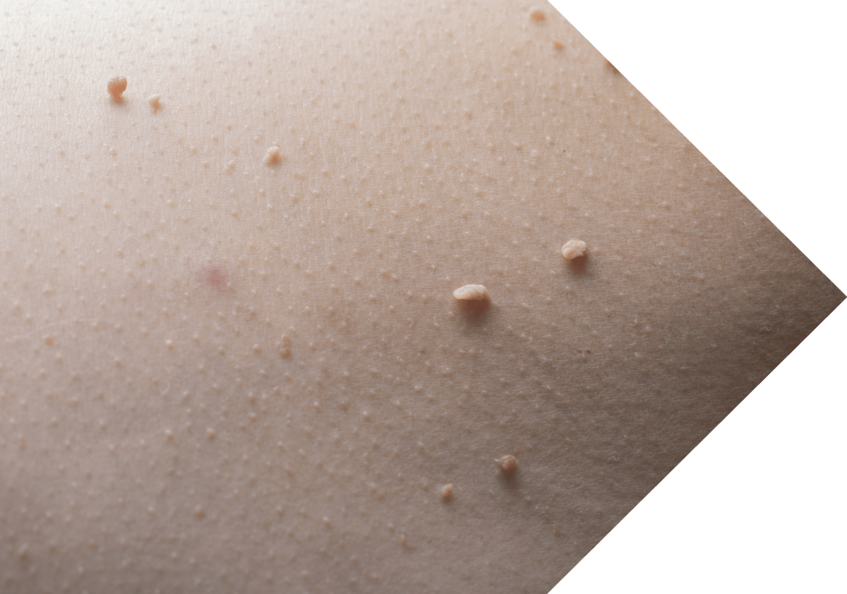 close up image of skin tags
