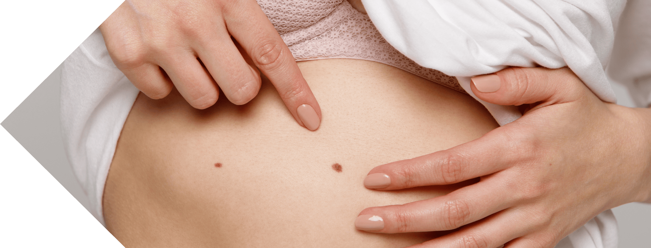 woman with an intimate skin tag